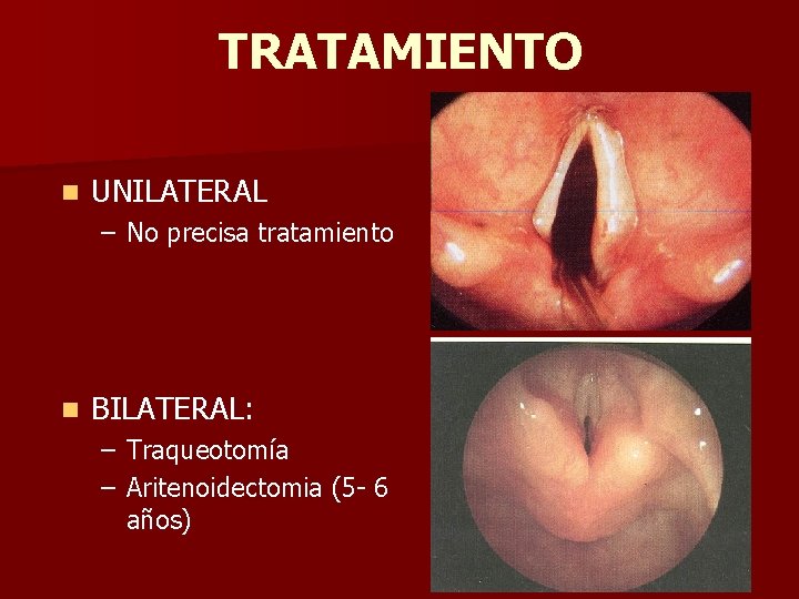 TRATAMIENTO n UNILATERAL – No precisa tratamiento n BILATERAL: – Traqueotomía – Aritenoidectomia (5 TRATAMIENTO n UNILATERAL – No precisa tratamiento n BILATERAL: – Traqueotomía – Aritenoidectomia (5