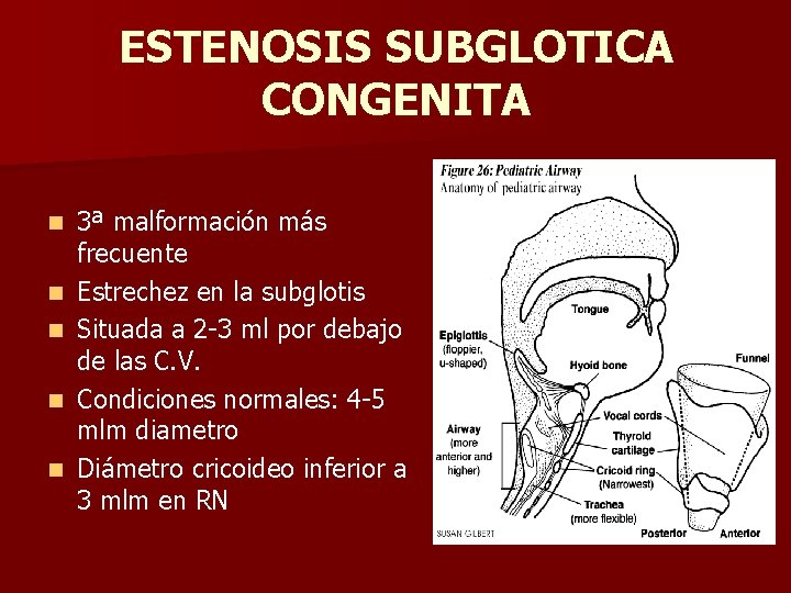 ESTENOSIS SUBGLOTICA CONGENITA n n n 3ª malformación más frecuente Estrechez en la subglotis ESTENOSIS SUBGLOTICA CONGENITA n n n 3ª malformación más frecuente Estrechez en la subglotis