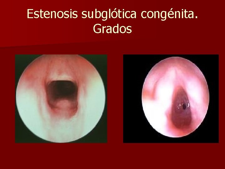 Estenosis subglótica congénita. Grados Estenosis subglótica congénita. Grados
