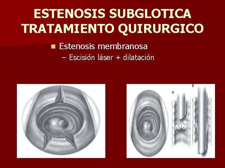 ESTENOSIS SUBGLOTICA TRATAMIENTO QUIRURGICO n Estenosis membranosa – Escisión láser + dilatación ESTENOSIS SUBGLOTICA TRATAMIENTO QUIRURGICO n Estenosis membranosa – Escisión láser + dilatación