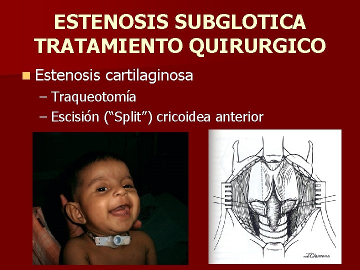 ESTENOSIS SUBGLOTICA TRATAMIENTO QUIRURGICO n Estenosis cartilaginosa – Traqueotomía – Escisión (“Split”) cricoidea anterior ESTENOSIS SUBGLOTICA TRATAMIENTO QUIRURGICO n Estenosis cartilaginosa – Traqueotomía – Escisión (“Split”) cricoidea anterior