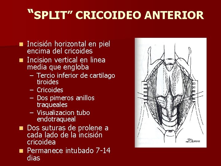 “SPLIT” CRICOIDEO ANTERIOR Incisión horizontal en piel encima del cricoides n Incision vertical en “SPLIT” CRICOIDEO ANTERIOR Incisión horizontal en piel encima del cricoides n Incision vertical en