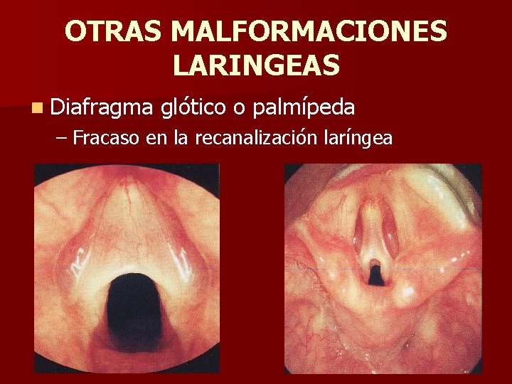 OTRAS MALFORMACIONES LARINGEAS n Diafragma glótico o palmípeda – Fracaso en la recanalización laríngea OTRAS MALFORMACIONES LARINGEAS n Diafragma glótico o palmípeda – Fracaso en la recanalización laríngea