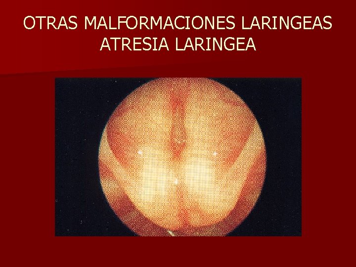 OTRAS MALFORMACIONES LARINGEAS ATRESIA LARINGEA OTRAS MALFORMACIONES LARINGEAS ATRESIA LARINGEA