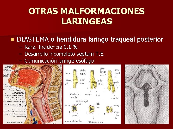 OTRAS MALFORMACIONES LARINGEAS n DIASTEMA o hendidura laringo traqueal posterior – Rara. Incidencia 0. OTRAS MALFORMACIONES LARINGEAS n DIASTEMA o hendidura laringo traqueal posterior – Rara. Incidencia 0.