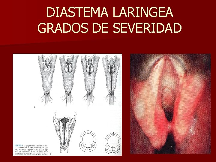 DIASTEMA LARINGEA GRADOS DE SEVERIDAD DIASTEMA LARINGEA GRADOS DE SEVERIDAD