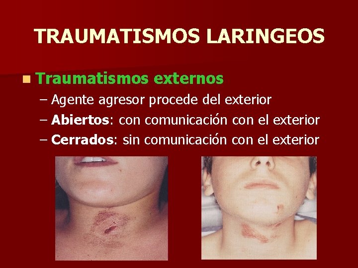 TRAUMATISMOS LARINGEOS n Traumatismos externos – Agente agresor procede del exterior – Abiertos: con TRAUMATISMOS LARINGEOS n Traumatismos externos – Agente agresor procede del exterior – Abiertos: con