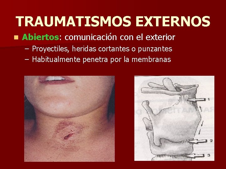 TRAUMATISMOS EXTERNOS n Abiertos: comunicación con el exterior – Proyectiles, heridas cortantes o punzantes TRAUMATISMOS EXTERNOS n Abiertos: comunicación con el exterior – Proyectiles, heridas cortantes o punzantes