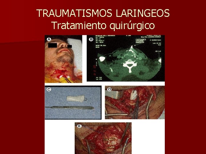 TRAUMATISMOS LARINGEOS Tratamiento quirúrgico TRAUMATISMOS LARINGEOS Tratamiento quirúrgico