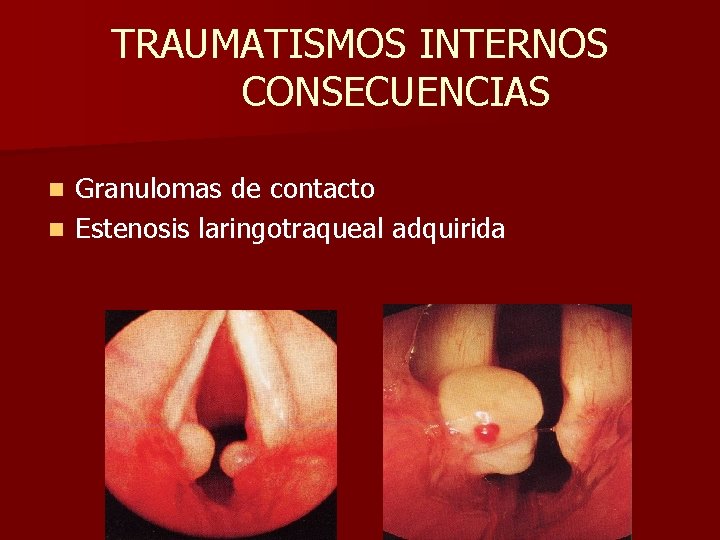 TRAUMATISMOS INTERNOS CONSECUENCIAS Granulomas de contacto n Estenosis laringotraqueal adquirida n TRAUMATISMOS INTERNOS CONSECUENCIAS Granulomas de contacto n Estenosis laringotraqueal adquirida n