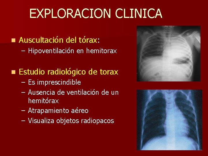 EXPLORACION CLINICA n Auscultación del tórax: – Hipoventilación en hemitorax n Estudio radiológico de EXPLORACION CLINICA n Auscultación del tórax: – Hipoventilación en hemitorax n Estudio radiológico de