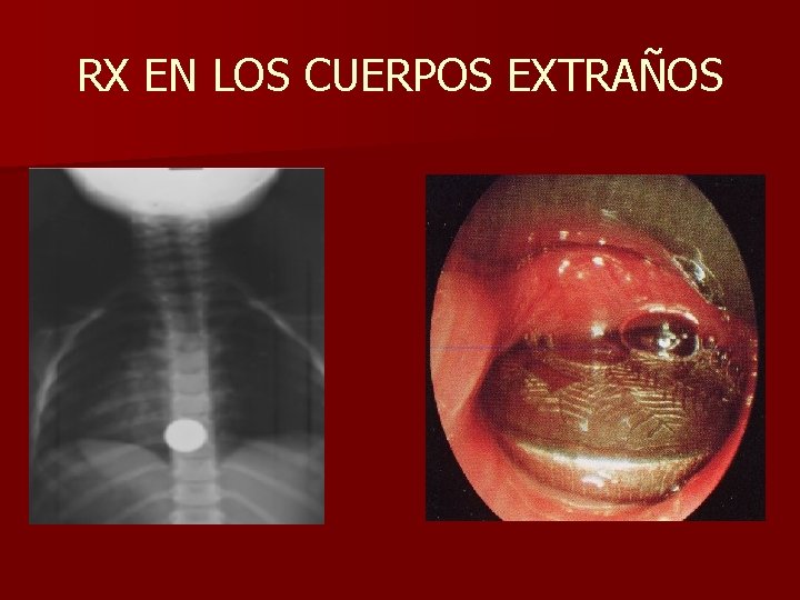 RX EN LOS CUERPOS EXTRAÑOS RX EN LOS CUERPOS EXTRAÑOS