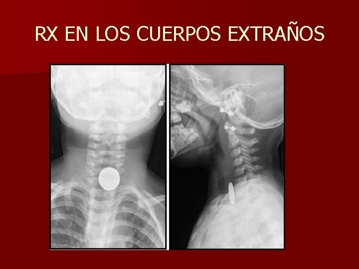 RX EN LOS CUERPOS EXTRAÑOS RX EN LOS CUERPOS EXTRAÑOS