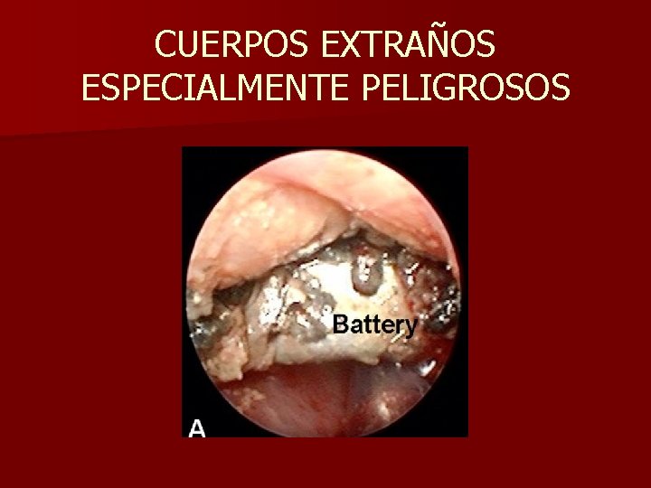 CUERPOS EXTRAÑOS ESPECIALMENTE PELIGROSOS CUERPOS EXTRAÑOS ESPECIALMENTE PELIGROSOS