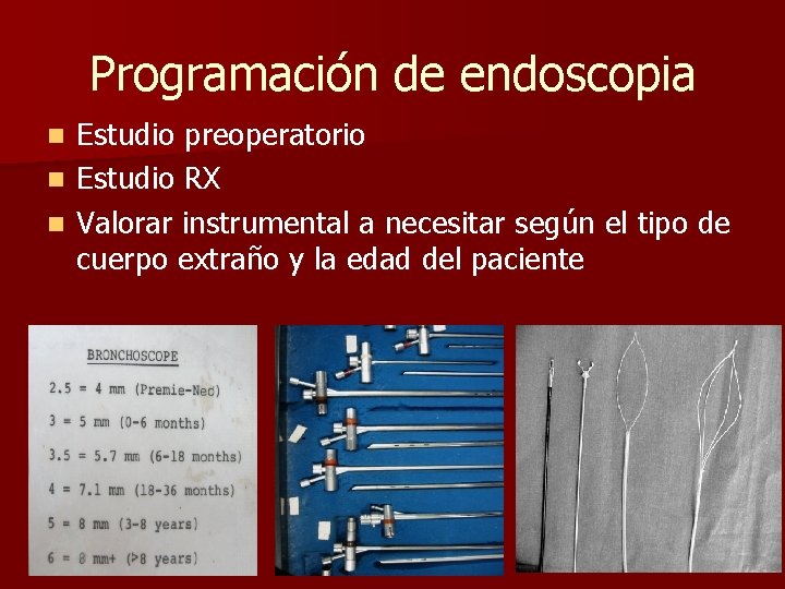 Programación de endoscopia Estudio preoperatorio n Estudio RX n Valorar instrumental a necesitar según Programación de endoscopia Estudio preoperatorio n Estudio RX n Valorar instrumental a necesitar según