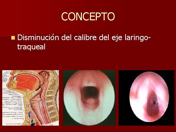 CONCEPTO n Disminución traqueal del calibre del eje laringo- CONCEPTO n Disminución traqueal del calibre del eje laringo-