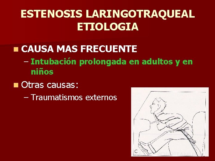 ESTENOSIS LARINGOTRAQUEAL ETIOLOGIA n CAUSA MAS FRECUENTE – Intubación prolongada en adultos y en ESTENOSIS LARINGOTRAQUEAL ETIOLOGIA n CAUSA MAS FRECUENTE – Intubación prolongada en adultos y en
