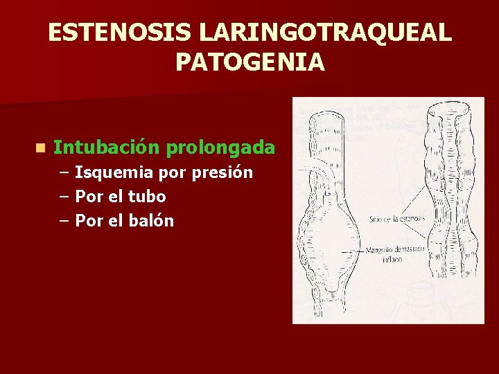 ESTENOSIS LARINGOTRAQUEAL PATOGENIA n Intubación prolongada – Isquemia por presión – Por el tubo ESTENOSIS LARINGOTRAQUEAL PATOGENIA n Intubación prolongada – Isquemia por presión – Por el tubo