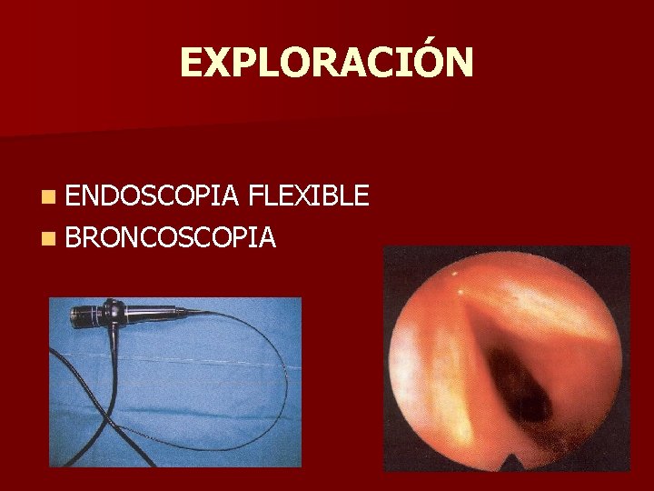 EXPLORACIÓN n ENDOSCOPIA FLEXIBLE n BRONCOSCOPIA EXPLORACIÓN n ENDOSCOPIA FLEXIBLE n BRONCOSCOPIA