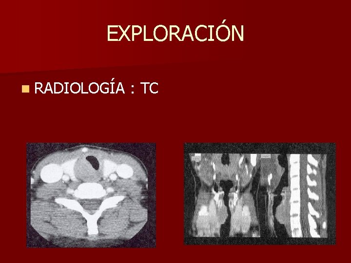 EXPLORACIÓN n RADIOLOGÍA : TC EXPLORACIÓN n RADIOLOGÍA : TC