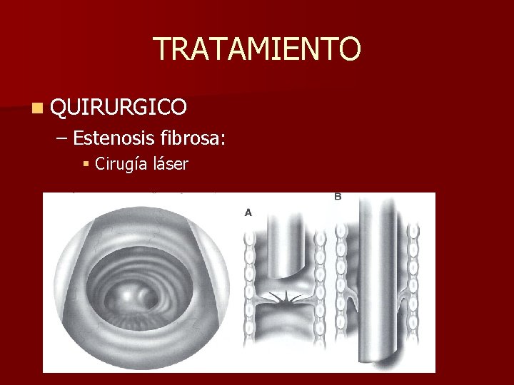 TRATAMIENTO n QUIRURGICO – Estenosis fibrosa: § Cirugía láser TRATAMIENTO n QUIRURGICO – Estenosis fibrosa: § Cirugía láser