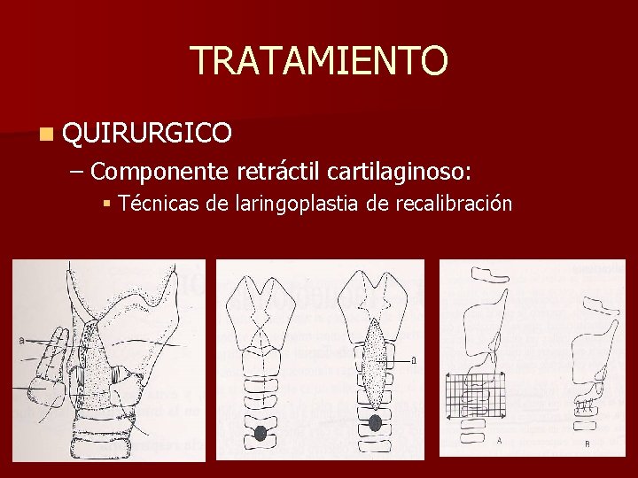 TRATAMIENTO n QUIRURGICO – Componente retráctil cartilaginoso: § Técnicas de laringoplastia de recalibración TRATAMIENTO n QUIRURGICO – Componente retráctil cartilaginoso: § Técnicas de laringoplastia de recalibración