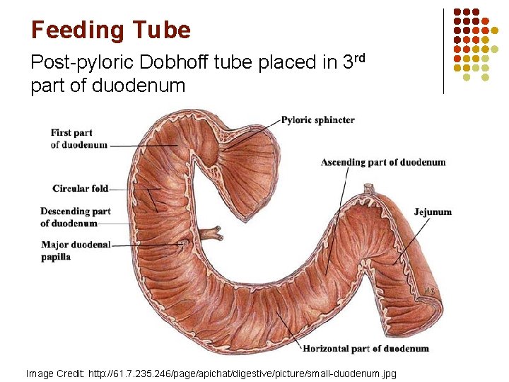 Feeding Tube Post-pyloric Dobhoff tube placed in 3 rd part of duodenum Image Credit: Feeding Tube Post-pyloric Dobhoff tube placed in 3 rd part of duodenum Image Credit: