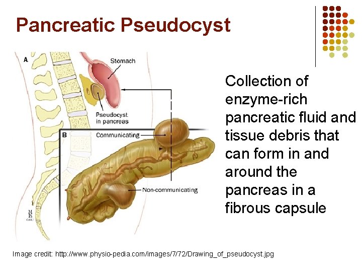 Pancreatic Pseudocyst l Collection of enzyme-rich pancreatic fluid and tissue debris that can form Pancreatic Pseudocyst l Collection of enzyme-rich pancreatic fluid and tissue debris that can form