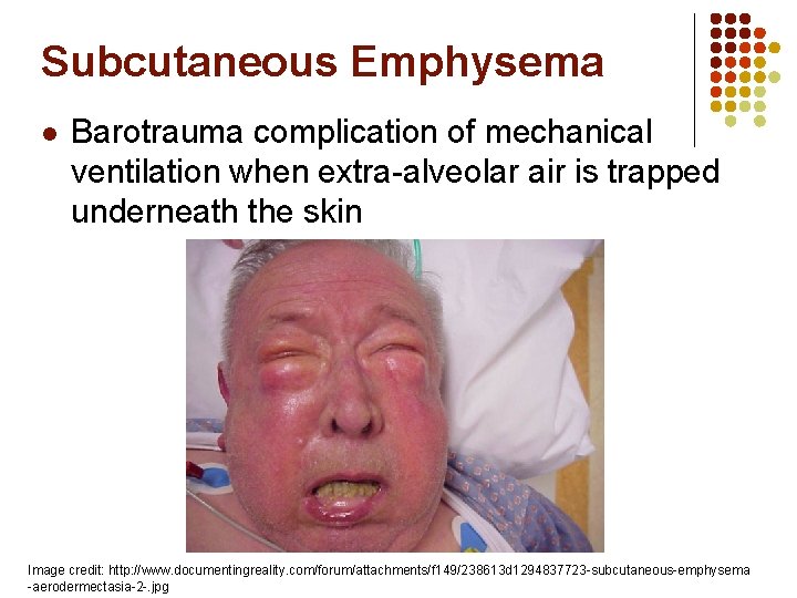 Subcutaneous Emphysema l Barotrauma complication of mechanical ventilation when extra-alveolar air is trapped underneath Subcutaneous Emphysema l Barotrauma complication of mechanical ventilation when extra-alveolar air is trapped underneath