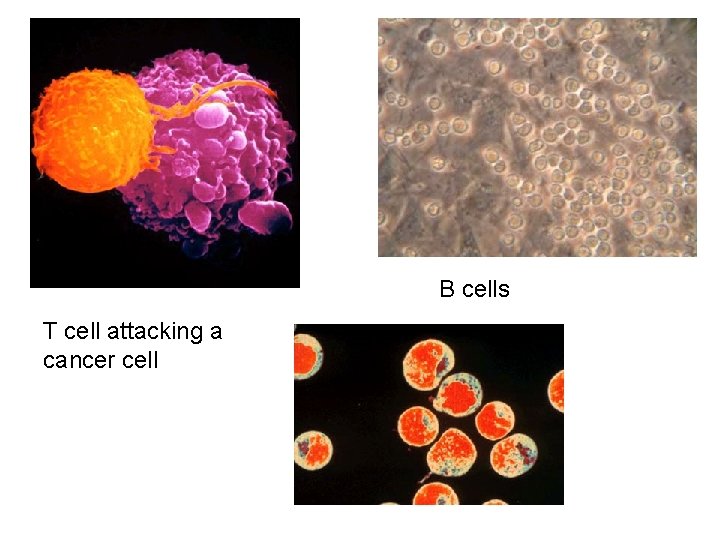 B cells T cell attacking a cancer cell 