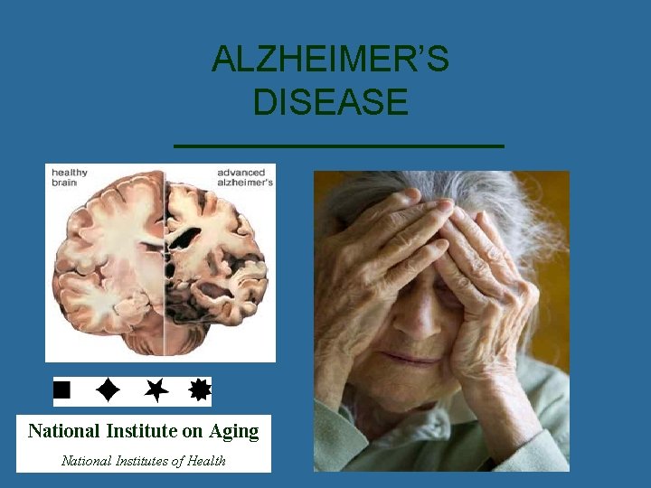 ALZHEIMER’S DISEASE National Institute on Aging National Institutes of Health 