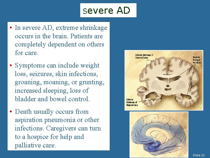Severe AD • In severe AD, extreme shrinkage occurs in the brain. Patients are