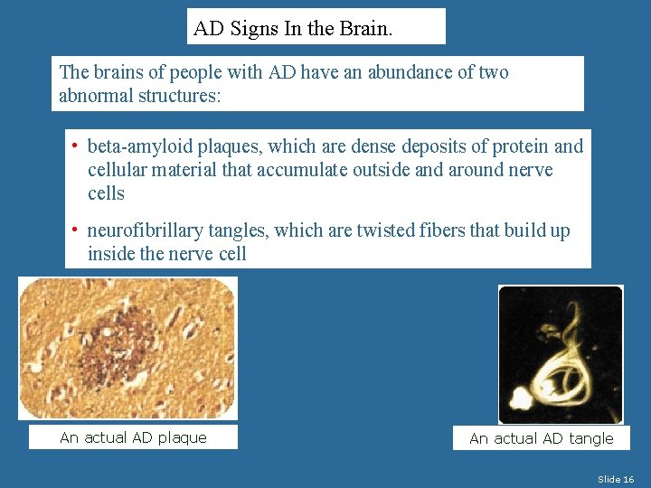 AD Signs In the Brain. The brains of people with AD have an abundance