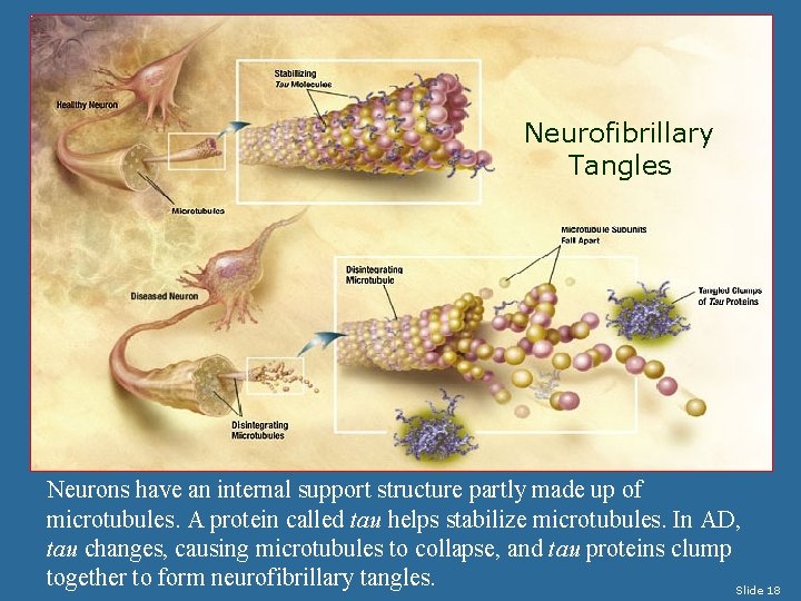 Neurofibrillary Tangles Neurons have an internal support structure partly made up of microtubules. A