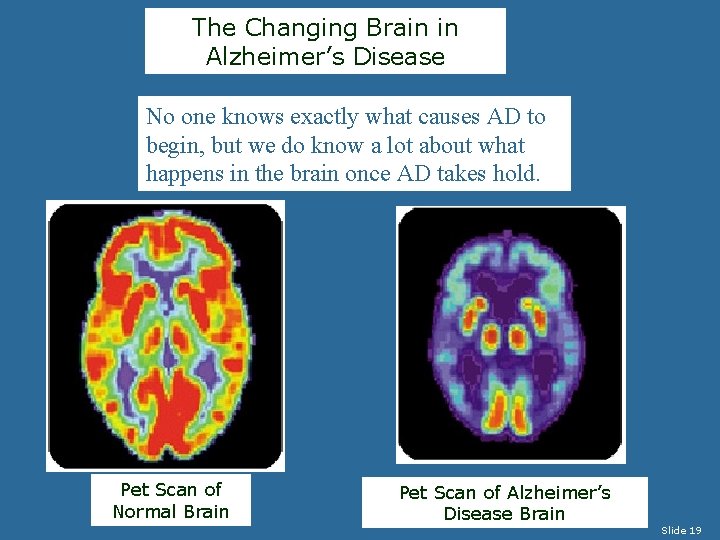 The Changing Brain in Alzheimer’s Disease No one knows exactly what causes AD to