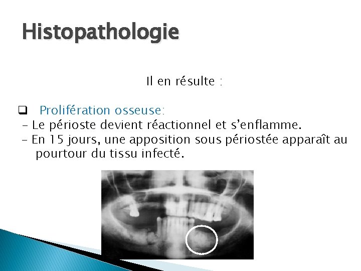 Histopathologie Il en résulte : q Prolifération osseuse: - Le périoste devient réactionnel et
