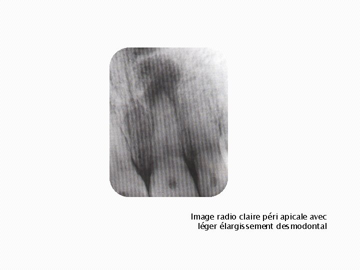Image radio claire péri apicale avec léger élargissement desmodontal 