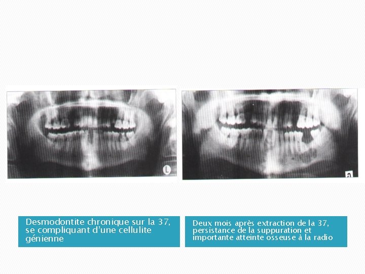 Desmodontite chronique sur la 37, se compliquant d’une cellulite génienne Deux mois après extraction