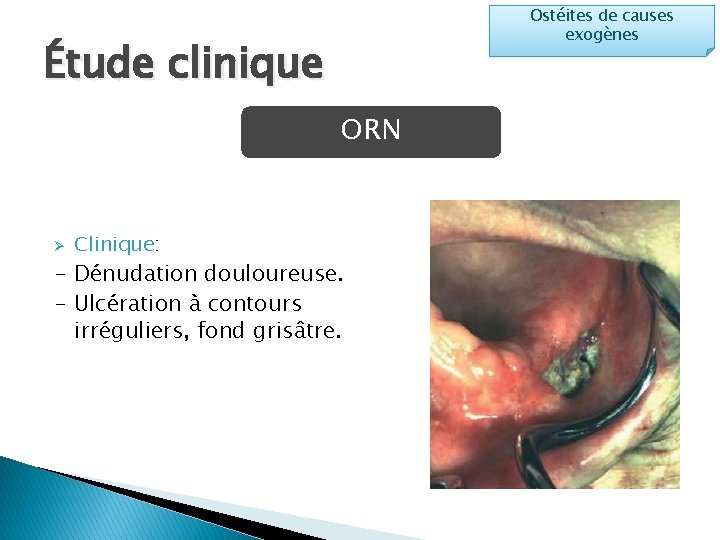 Ostéites de causes exogènes Étude clinique ORN Ø Clinique: - Dénudation douloureuse. - Ulcération