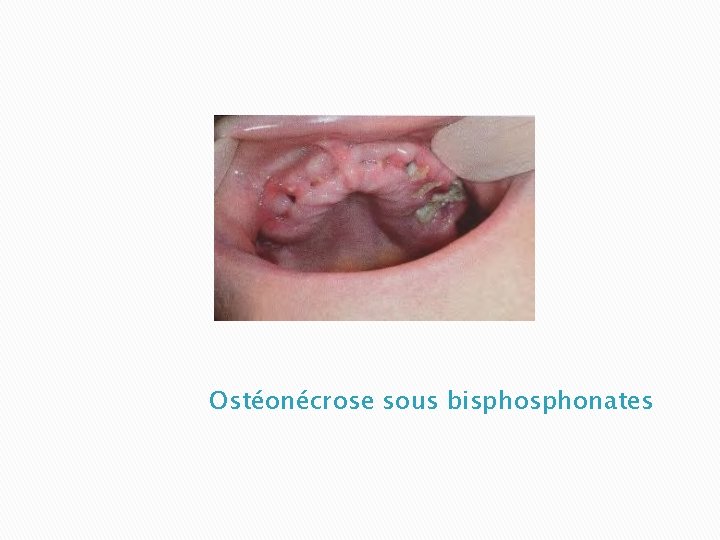 Ostéonécrose sous bisphonates 