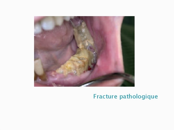 Fracture pathologique 