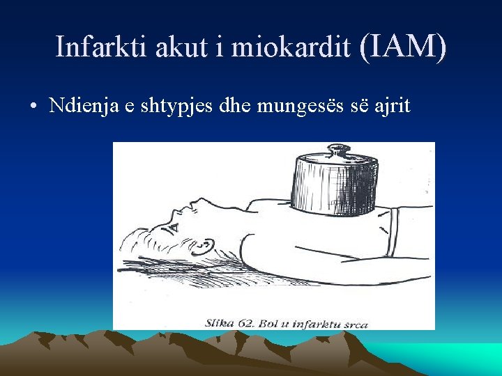 Infarkti akut i miokardit (IAM) • Ndienja e shtypjes dhe mungesës së ajrit 
