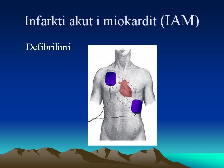 Infarkti akut i miokardit (IAM) Defibrilimi 