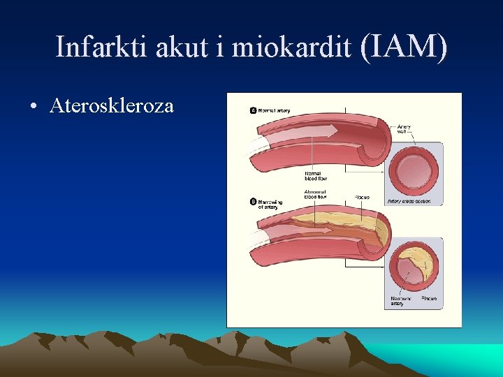 Infarkti akut i miokardit (IAM) • Ateroskleroza 