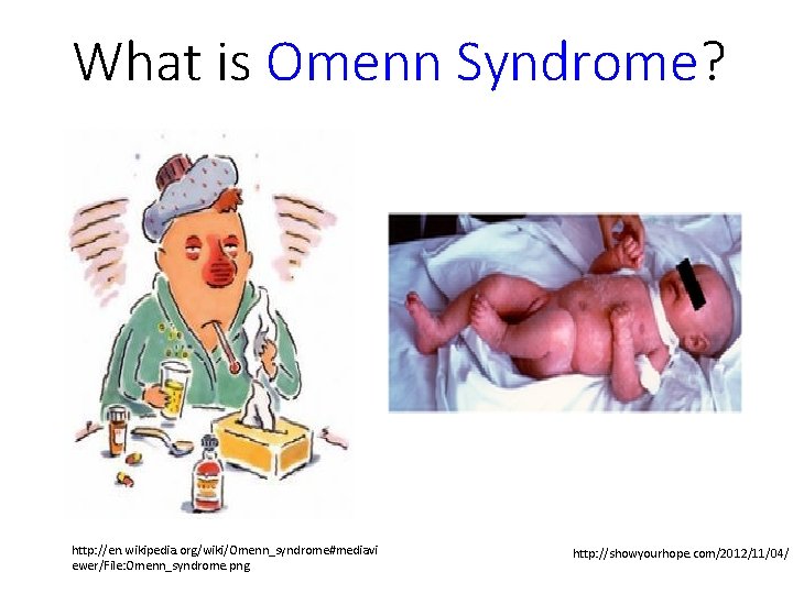 What is Omenn Syndrome? http: //en. wikipedia. org/wiki/Omenn_syndrome#mediavi ewer/File: Omenn_syndrome. png http: //showyourhope. com/2012/11/04/