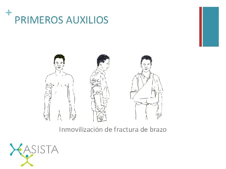 + PRIMEROS AUXILIOS Inmovilización de fractura de brazo 