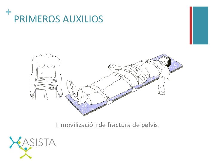 + PRIMEROS AUXILIOS Inmovilización de fractura de pelvis. 