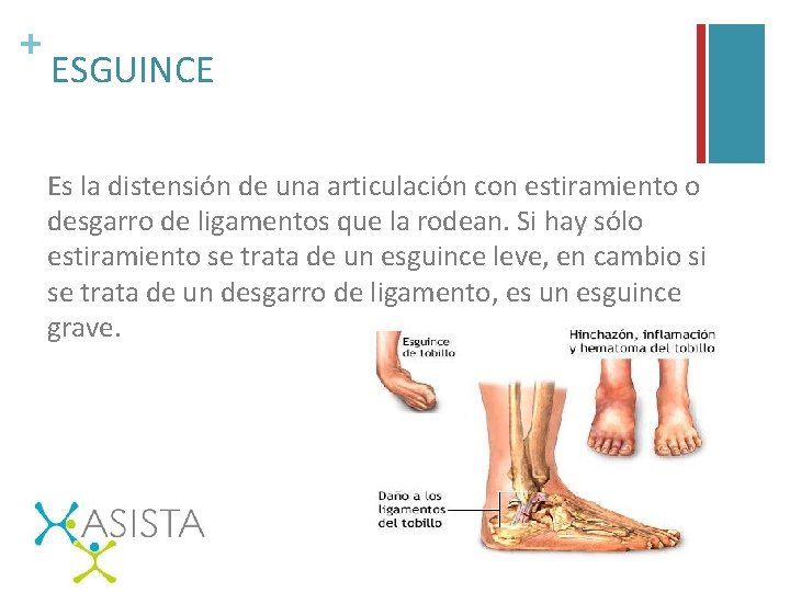 + ESGUINCE Es la distensión de una articulación con estiramiento o desgarro de ligamentos