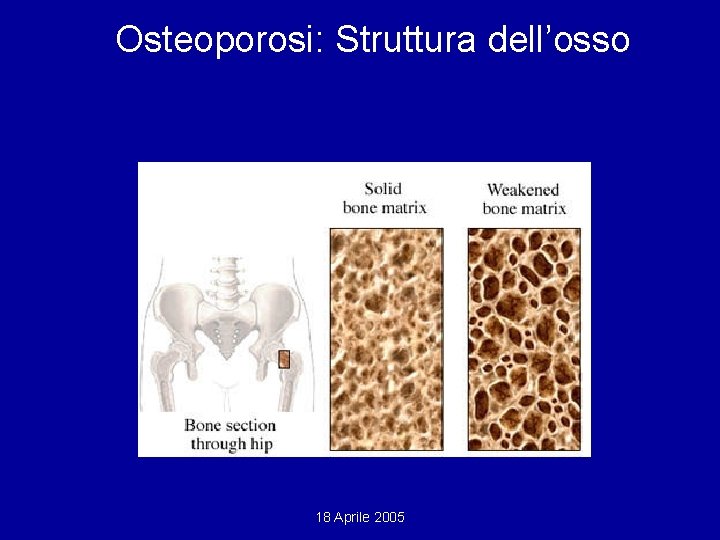 Osteoporosi: Struttura dell’osso 18 Aprile 2005 