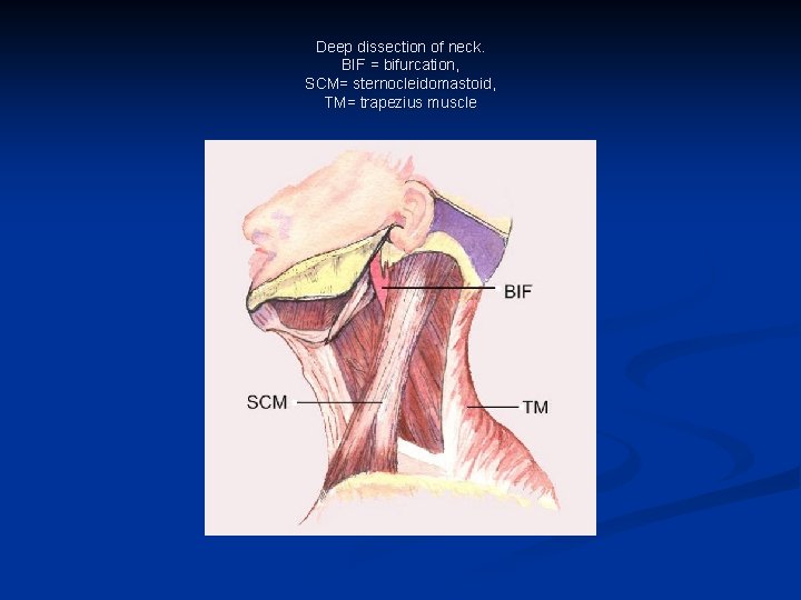Deep dissection of neck. BIF = bifurcation, SCM= sternocleidomastoid, TM= trapezius muscle 